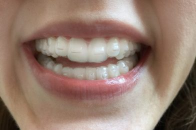 Drawbacks of Invisalign. Is it Really Worth the Cost?